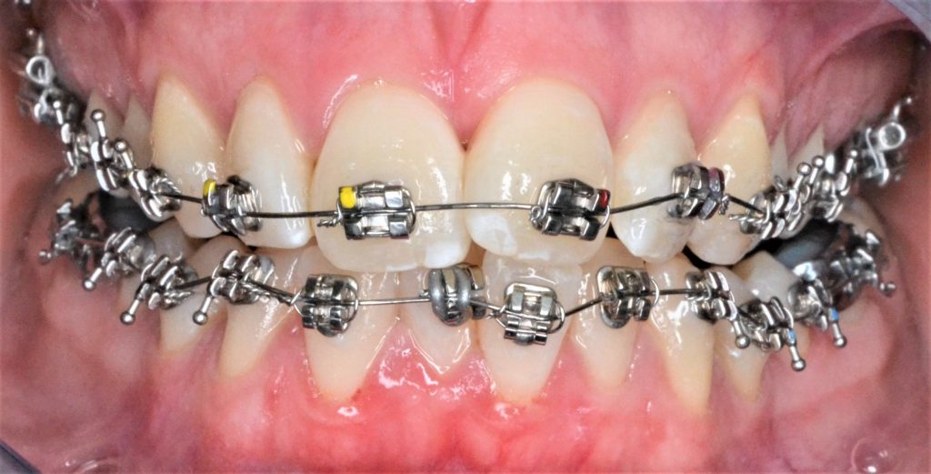 slaaf mild Samenstelling Beugels | Invisalign | Slotjes | Tandartspraktijk De Stip